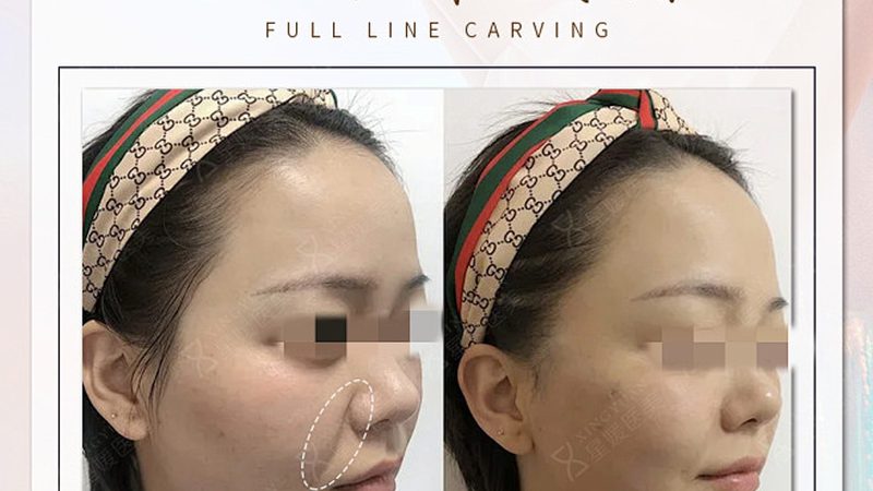 术后恢复期，为什么有人消肿快有人慢