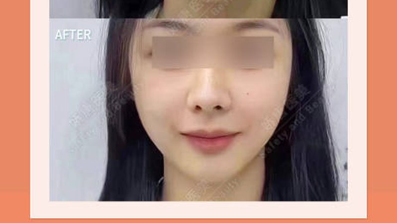 光子嫩肤与点阵激光：揭秘两种美容技术的差异