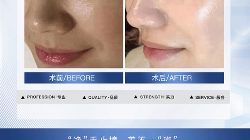 激光美容与光子嫩肤：流程解析与区别解读