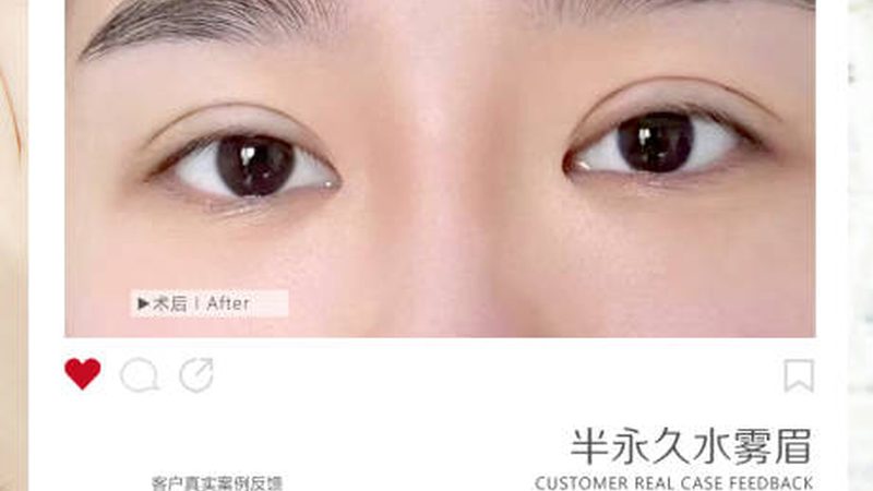 小标题：双眼皮手术，安全与美丽并行