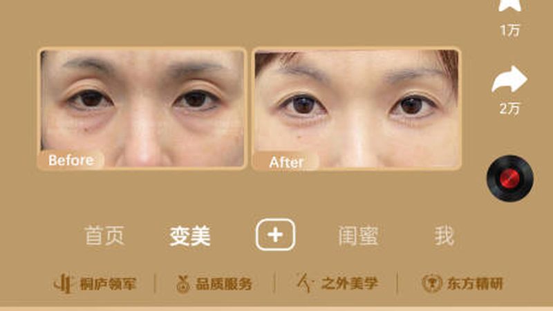 光子嫩肤，如何选择仪器厂家直供？揭秘关键因素**