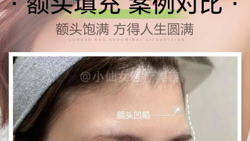 埋线提升法令纹，术后护理攻略揭秘
